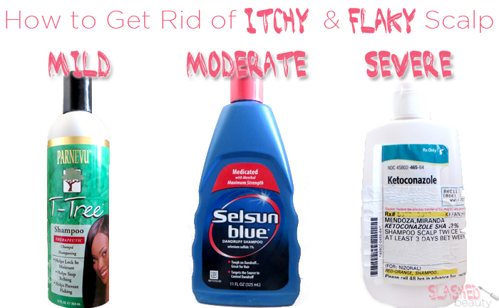 how to get rid of itchy flaky scalp