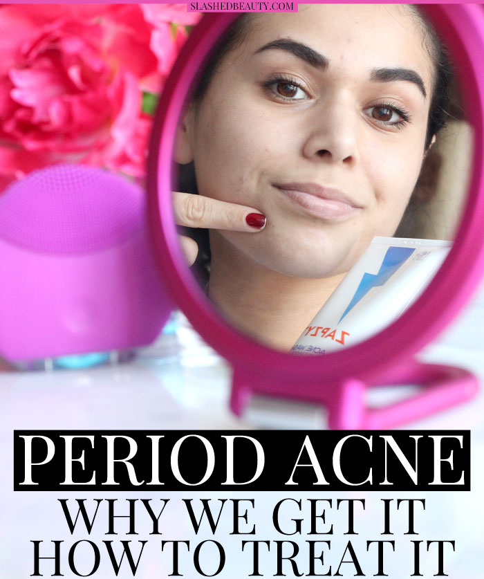 Find out why we get period acne-- why stubborn pimples appear and how to treat them -- I'm using ZAPZYT! | Slashed Beauty