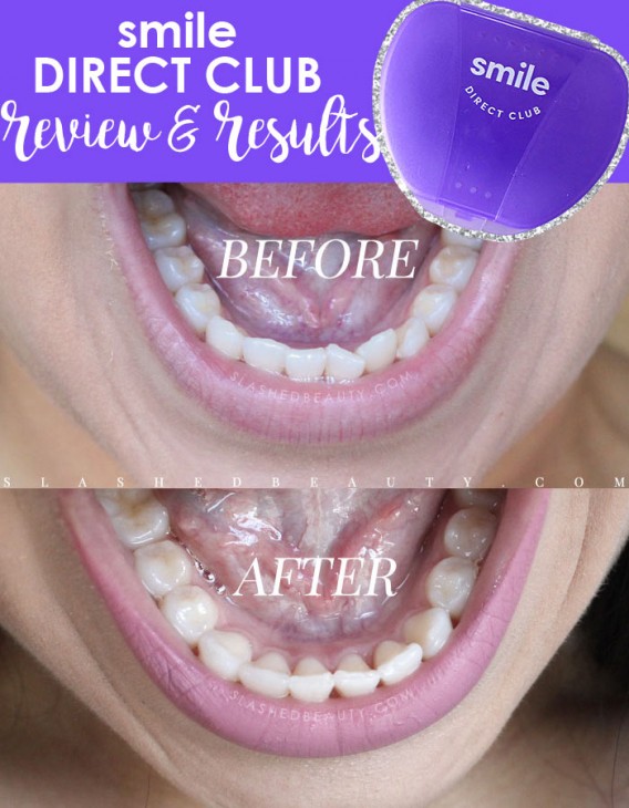 REVIEW Smile Direct Club (Before & After) Slashed Beauty