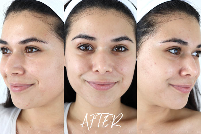 My First Chemical Peel: See the before & after and learn what to expect when you go in for a chemical peel. | Slashed Beauty