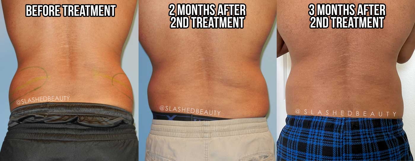 Coolsculpting for Men Love Handles Before & After | Does Coolsculpting Work? | Slashed Beauty