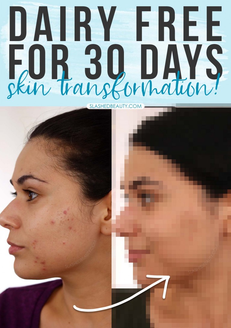 Going Dairy Free for Acne: My 30 Day Results
