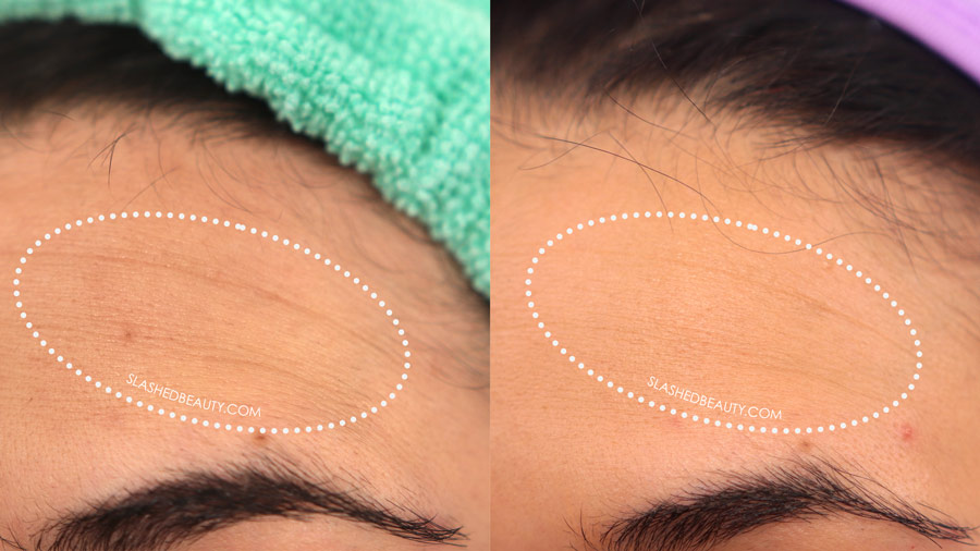 Solawave Before & After Results: Forehead expression lines with noticeable fading after 30 days| SolaWave Skin Care Wand Review | Slashed Beauty