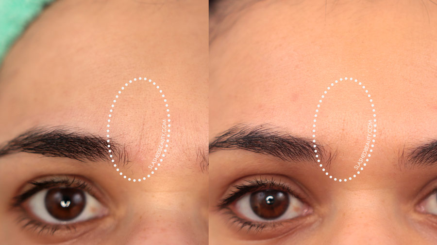 Solawave Before & After Results: Frown Lines / Elevens with noticeable fading after 30 days| SolaWave Skin Care Wand Review | Slashed Beauty