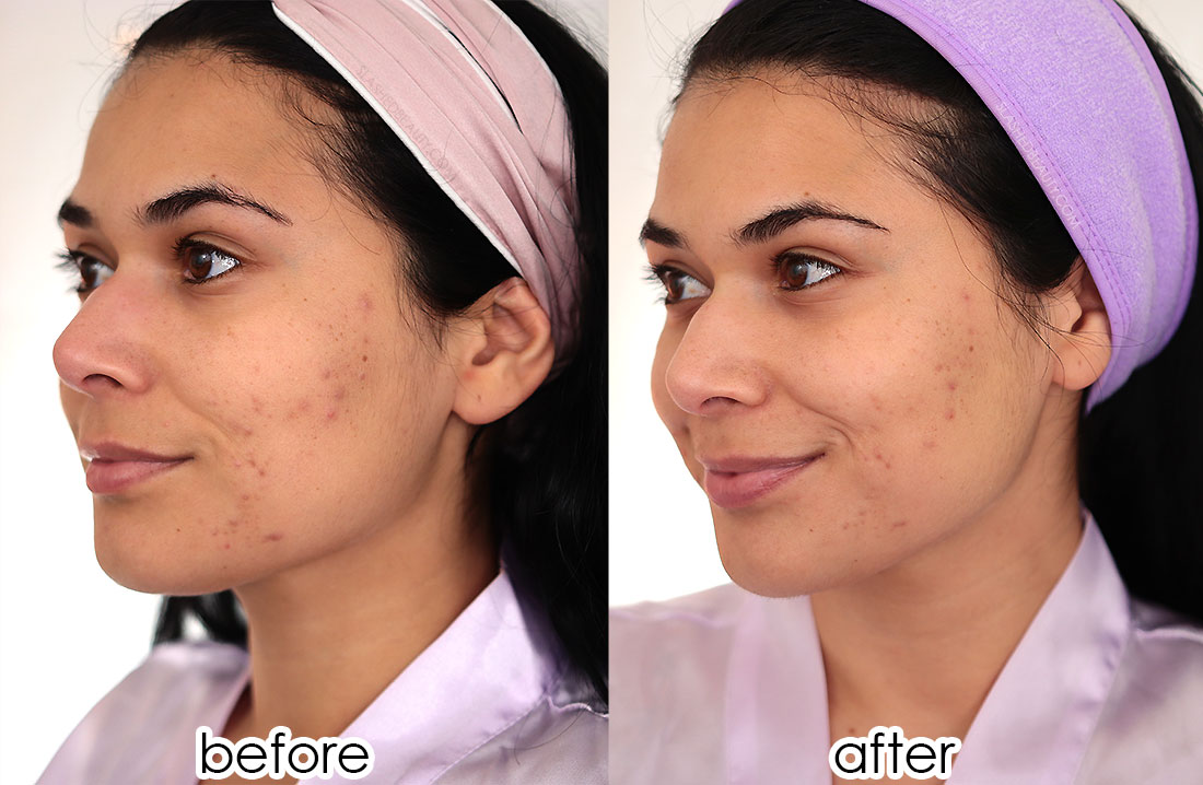 Before and After using The Banisher 2.0 Microneedling Device | Fade Acne Scars | Slashed Beauty