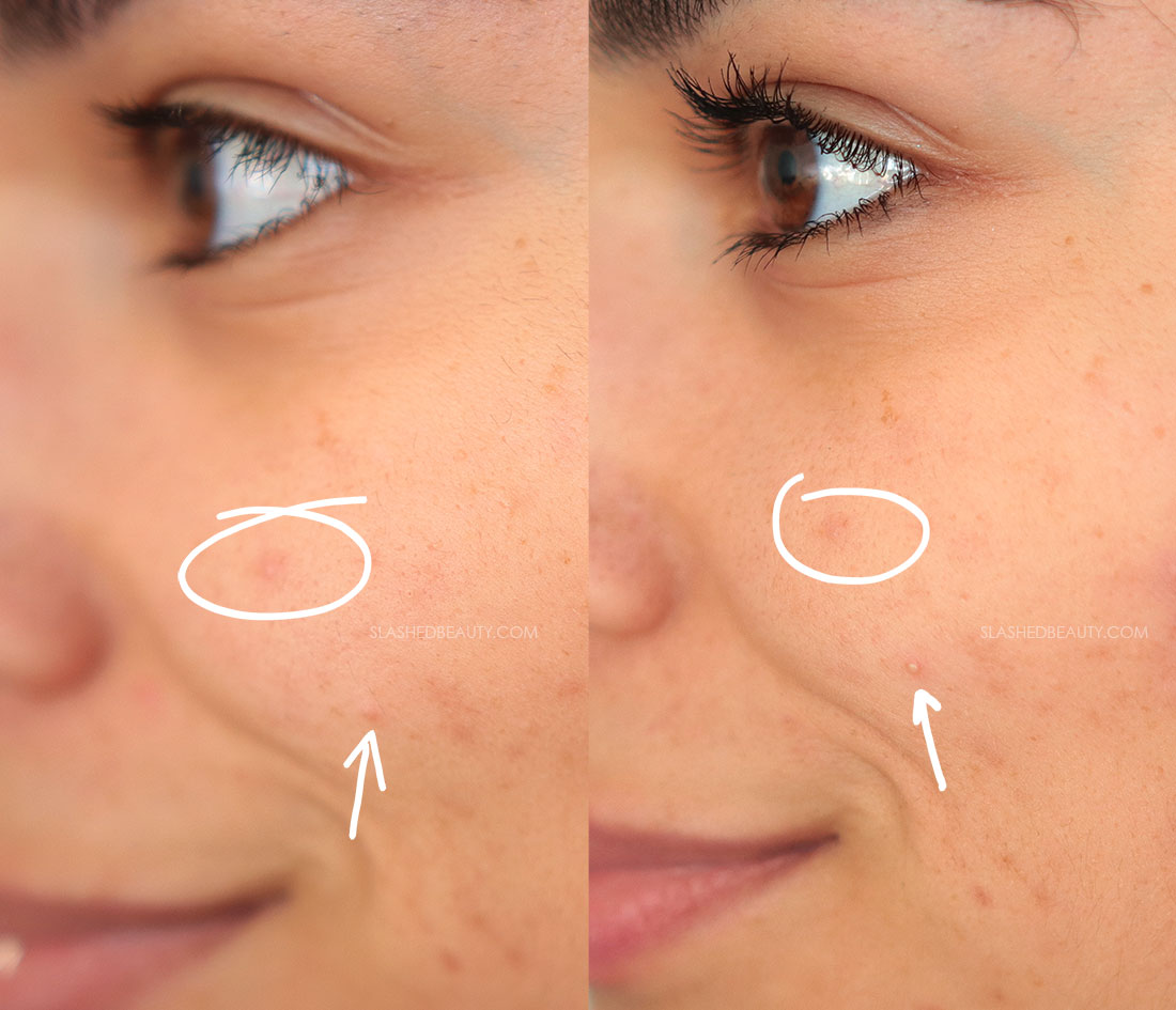 Before and after two pimples, showing them reduced redness after using Hydro-Stars |  5 Viral Skin Care Products Worth Trying At Walmart  Beauty cut